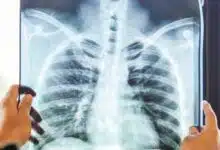 Casos de tuberculosis en Veracruz superan los 480 en lo que va del año