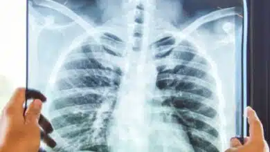 Casos de tuberculosis en Veracruz superan los 480 en lo que va del año