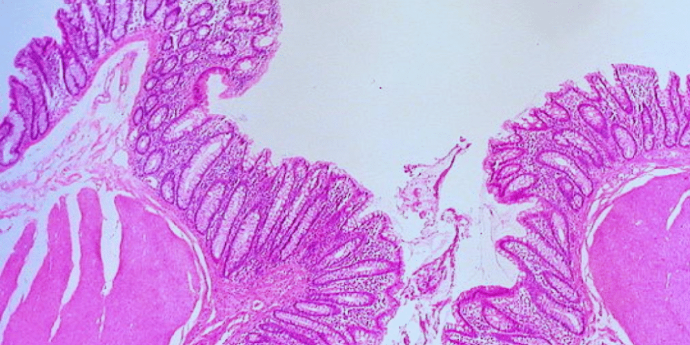 Alertan sobre la diverticulitis en Veracruz una enfermedad que afecta el colon