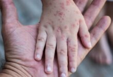 UNAM lanza advertencia tras "resurgimiento" del sarampión