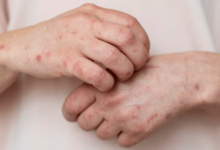 México reporta 1,926 casos de sarampión en 17 estados