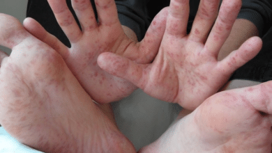 Brote de virus coxsackie en Veracruz activa alerta sanitaria
