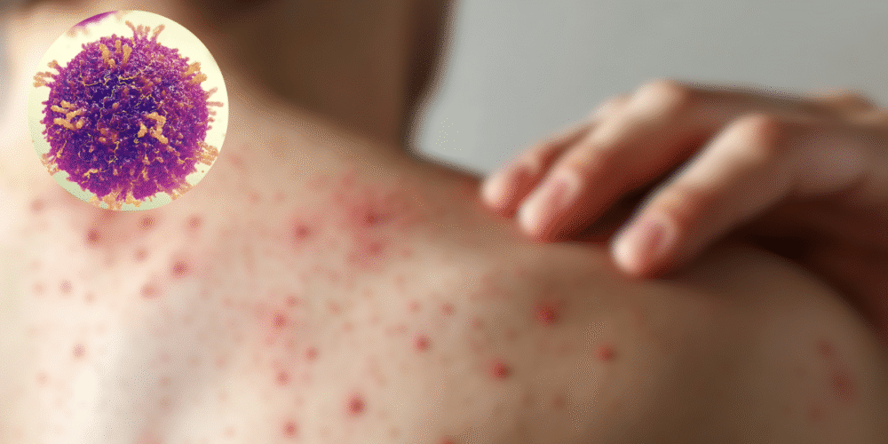 Crisis sanitaria México rebasa los 5,000 casos de sarampión y lidera la mortalidad en el continente