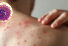 Crisis sanitaria México rebasa los 5,000 casos de sarampión y lidera la mortalidad en el continente