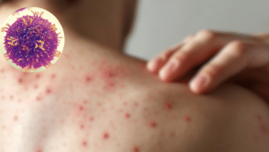 Crisis sanitaria México rebasa los 5,000 casos de sarampión y lidera la mortalidad en el continente