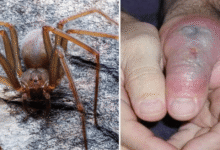 Piquete de araña violinista: ¿Cómo identificarla y qué hacer si te pica?