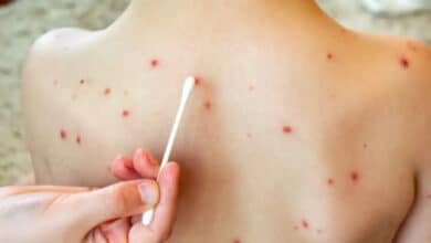 Sarampión en Veracruz: solicitan un millón de dosis para campaña (Foto de internet)