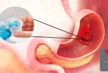 Científicos descubren cómo un simple enjuague bucal ayudaría a identificar el cáncer gástrico (Fotos internetredes)
