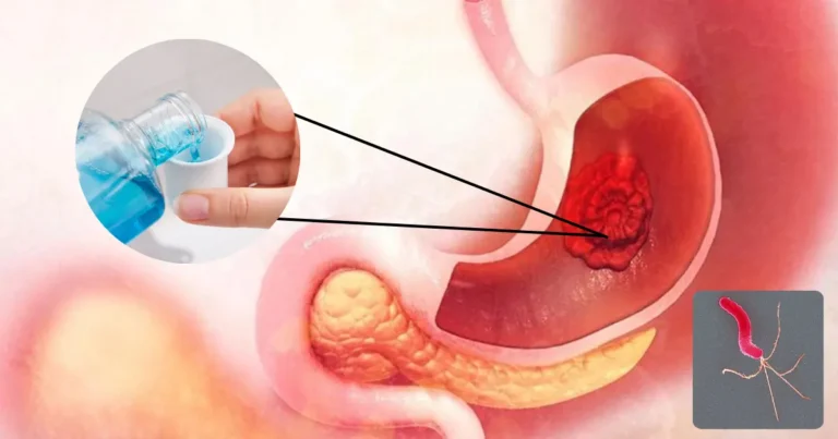 Científicos descubren cómo un simple enjuague bucal ayudaría a identificar el cáncer gástrico (Fotos internetredes)
